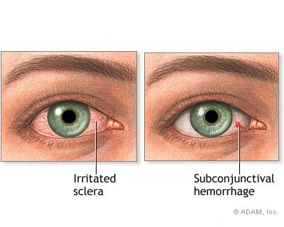 bloodshot eye after cataract surgery