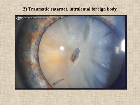 blow to head cataract trauma injury