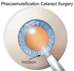 cataract surgery incision scratchy