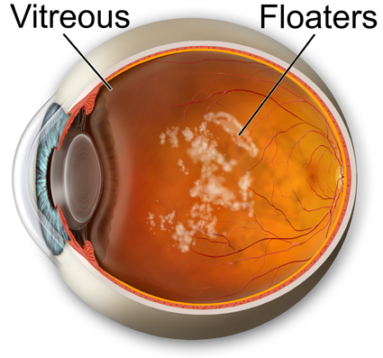 cataract surgery arc of light