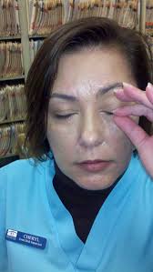 swollen eyelids after cataract surgery