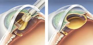 recovery of vision after cataract surgery